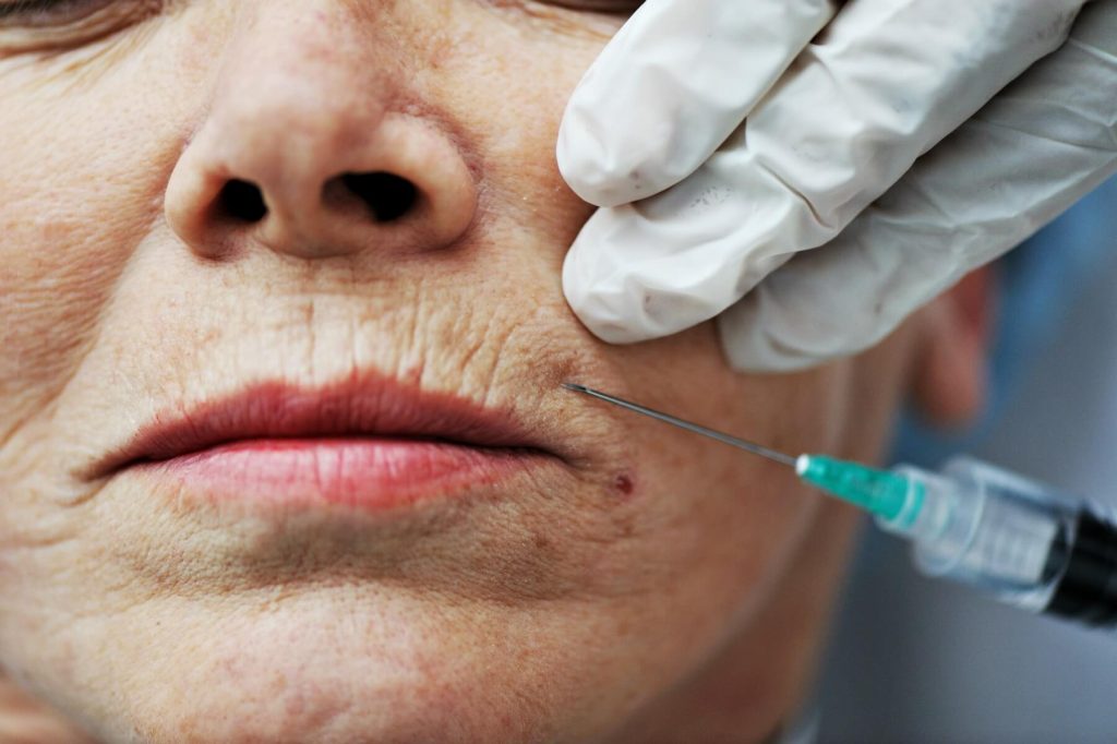 Woman having Botox injections put into her upper lip.